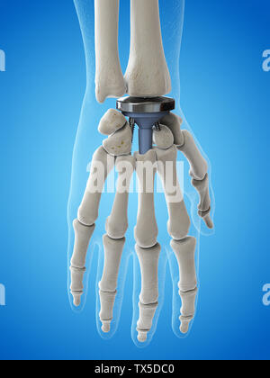 3d rendered medically accurate illustration of a wrist replacement Stock Photo