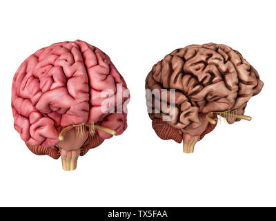 3d rendered illustration of a healthy and unhealthy brain Stock Photo ...