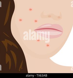 A young woman having acne infection problem skin concept vector illustration Stock Vector