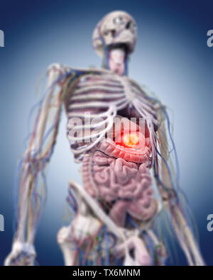 3d rendered medically accurate illustration of a stomach tumor Stock Photo