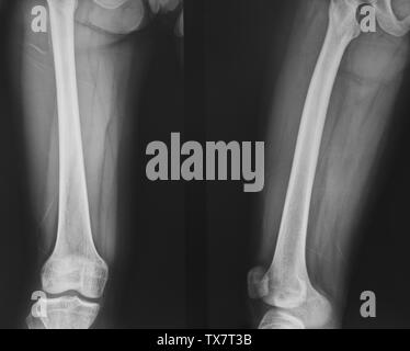 Collection of x-ray normal knee Stock Photo