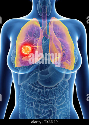 3d rendered medically accurate illustration of a womans lung cancer Stock Photo