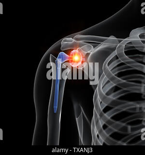 3d rendered medically accurate illustration of a shoulder replacement Stock Photo