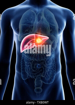 3d rendered medically accurate illustration of a mans liver cancer Stock Photo