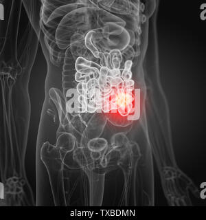 3d rendered medically accurate illustration of small intestine cancer Stock Photo