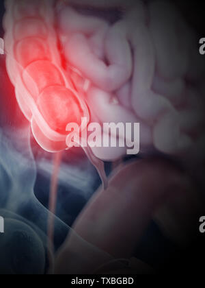 3d rendered, medically accurate illustration of an inflamed colon Stock Photo