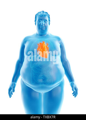 3d rendered medically accurate illustration of an obese mans heart Stock Photo