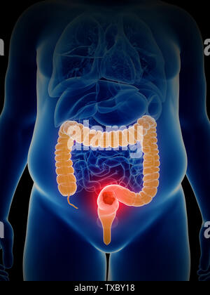 Inside of an unhealthy colon Stock Photo - Alamy