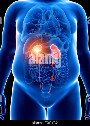 3d rendered medically accurate illustration of a obese man with a painful kidney Stock Photo