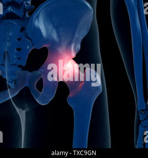 3d rendered medically accurate illustration of a painful hip joint Stock Photo