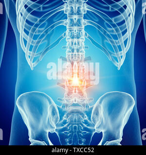 3d rendered illustration of a painful lumbar spine Stock Photo - Alamy