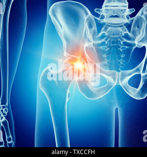 3d rendered medically accurate illustration of a painful hip joint Stock Photo