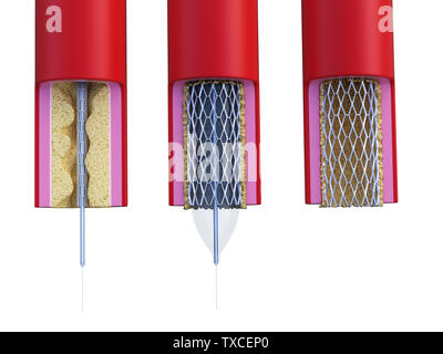 3d rendered medically accurate illustration of a stent being placed Stock Photo