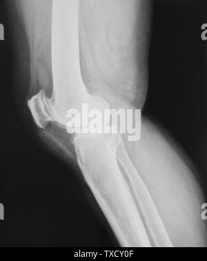 Collection of x-ray normal knee Stock Photo