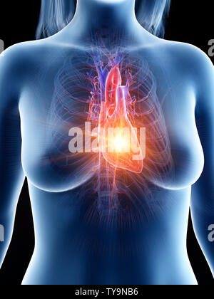 3d rendered medically accurate illustration of a heart attack Stock Photo