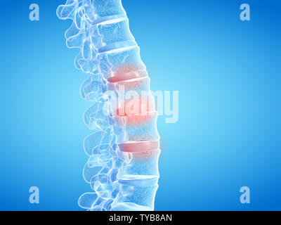 3d rendered medically accurate illustration of painful intervertebral discs Stock Photo