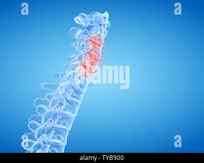 3d rendered medically accurate illustration of painful intervertebral discs Stock Photo