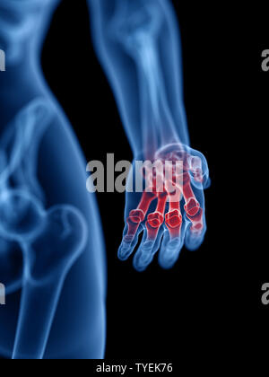 3d rendered medically accurate illustration of a painful hand Stock Photo