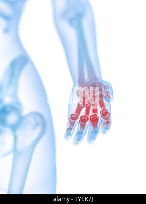 3d rendered medically accurate illustration of a painful hand Stock Photo