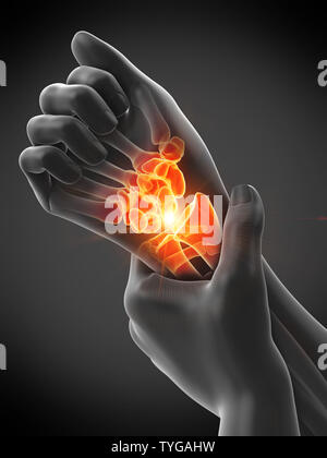 3d rendered medically accurate illustration of a mans painful wrist Stock Photo