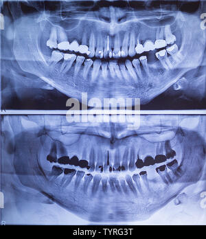 Dental X-Ray panoramic of upper and lower jaw Stock Photo