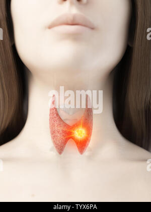 3d rendered medically accurate illustration of a woman having thyroid cancer Stock Photo