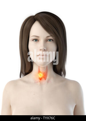 3d rendered medically accurate illustration of a woman having thyroid cancer Stock Photo