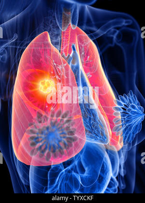 3d rendered medically accurate illustration of a womans lung tumor Stock Photo