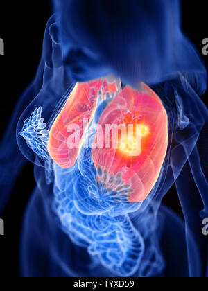 3d rendered medically accurate illustration of a womans lung tumor Stock Photo