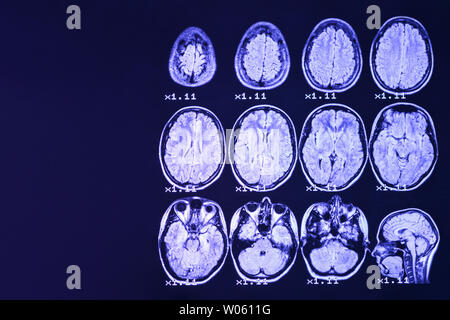 MRI of the brain on a black background with blue  backlight. Right  place for advertising inscription Stock Photo