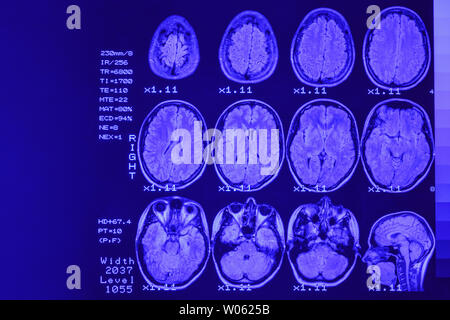 MRI scan or magnetic resonance image of head and brain scan. The result is an MRI of the brain with values and numbers with blue  backlight. Stock Photo