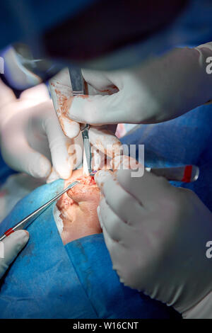 Surgeon and his assistant performing cosmetic surgery on nose in hospital operating room. Nose reshaping, augmentation. Rhinoplasty. Stock Photo