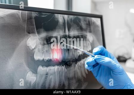 Doctor looking at human teeth x-ray on computer monitor. Modern dental clinic. Stock Photo