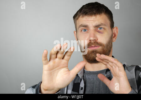 Man with real eye bruise Stock Photo