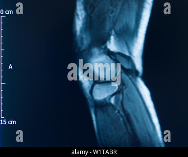 Knee sports injury mri mcl grade 2 tear magnetic resonance imaging orthopedic traumatology scan. Stock Photo