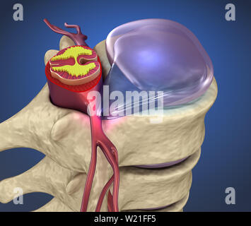 bulging disk xray