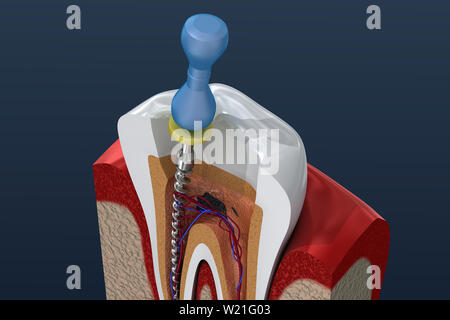 Root canal treatment process. 3D illustration Stock Photo - Alamy