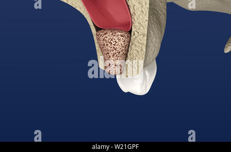 Sinus Lift Surgery - Sinus Augmentation. 3D illustration Stock Photo