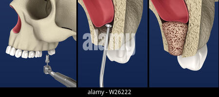 Sinus Lift Surgery - Sinus Augmentation. 3D illustration Stock Photo