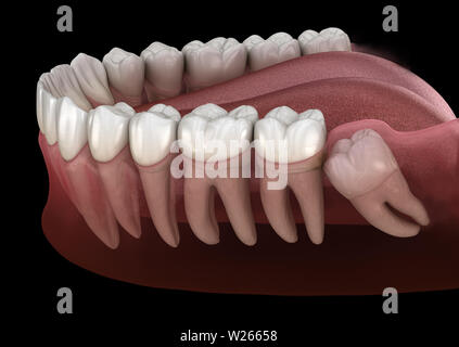 Healthy teeth and wisdom tooth with mesial impaction . Medically accurate tooth 3D illustration Stock Photo