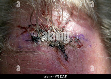 Close up of a scabby, stitched head wound on a older man's head Stock Photo
