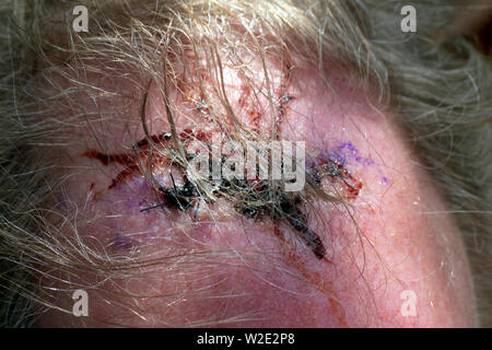 Close up of a scabby, stitched head wound on a older man's head Stock Photo