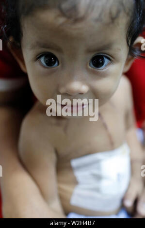 Calmette Hospital. Cardiac surgery ward.  Young girl.  Phnom Penh. Cambodia. Stock Photo