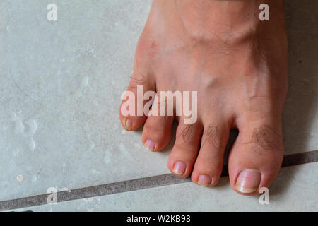 Close up of feet with a wound on the small finger Stock Photo