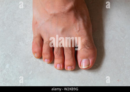 Close up of feet with a wound on the small finger Stock Photo