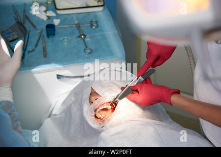 Surgery in the dental clinic. Sinus lifting operation. Stock Photo
