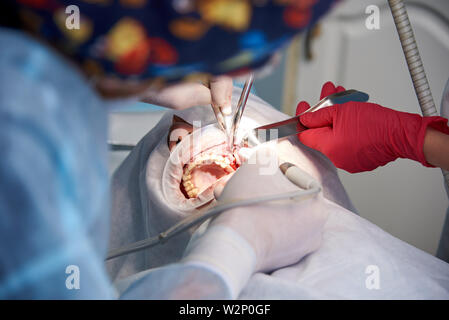 Surgery in the dental clinic. Sinus lifting operation. Stock Photo