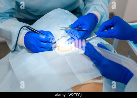 The surgeon does surgery to remove the mole on the patient's back. The process of burning moles in a private clinic to remove moles. Stock Photo