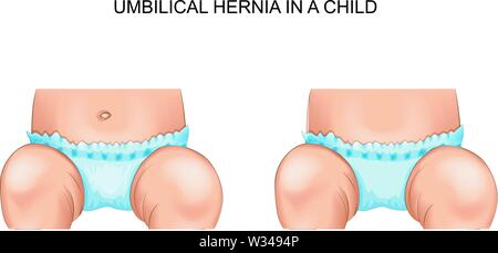vector illustration of an umbilical hernia in a child Stock Vector