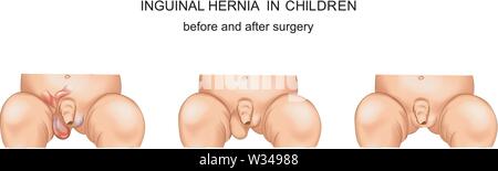 vector illustration of inguinal hernia in a child before and after surgery. Stock Vector
